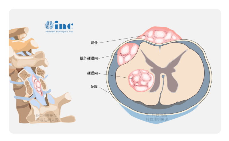 脊髓腫瘤又稱為椎管內(nèi)腫瘤
