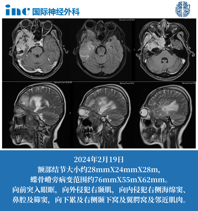 42歲女性-右側(cè)顳部、蝶骨嵴旁腦膜瘤復(fù)發(fā)