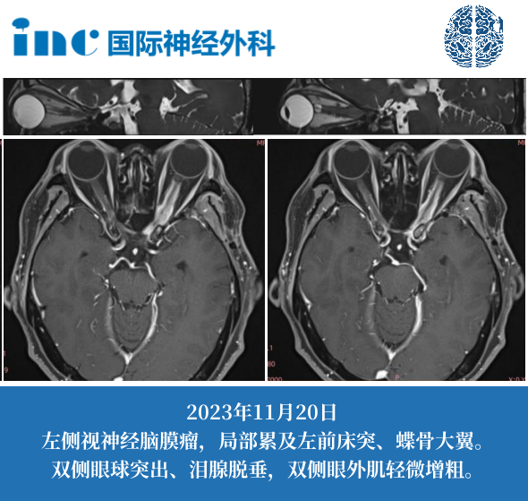 57歲女性-左側(cè)視神經(jīng)腦膜瘤（術(shù)后）  　　從沒想過腦腫瘤也會(huì)導(dǎo)致視力下降