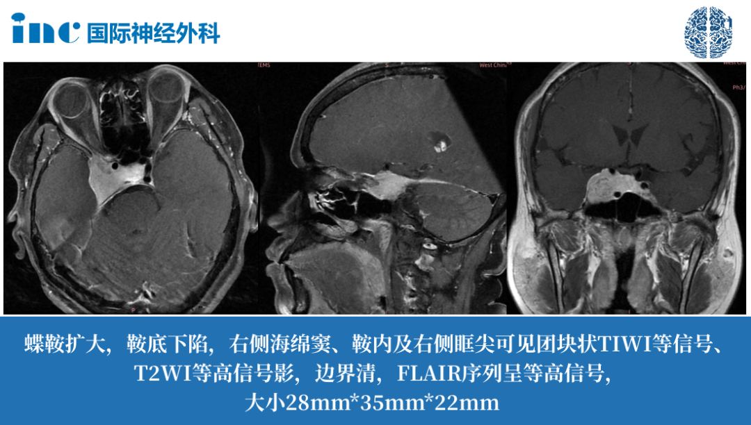 48歲男性-右側(cè)海綿竇、鞍內(nèi)及右側(cè)眶尖腦膜瘤  　　視力下降、突然發(fā)胖