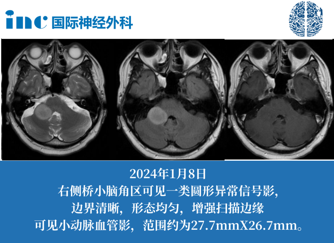 39歲男性-橋臂膠質瘤  　　身體無癥狀，卻意外查出膠質瘤！手術or被動觀察？