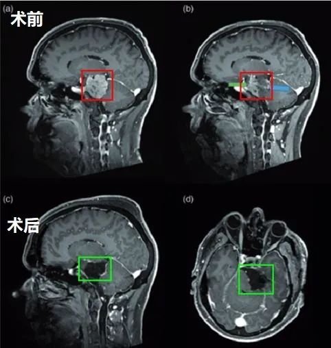 53歲男性高難度巖斜區(qū)腦膜瘤