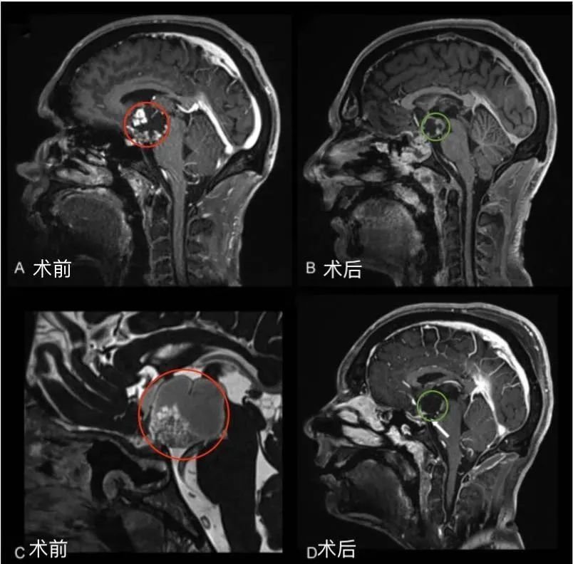 35歲男性后視交叉性較大顱咽管瘤