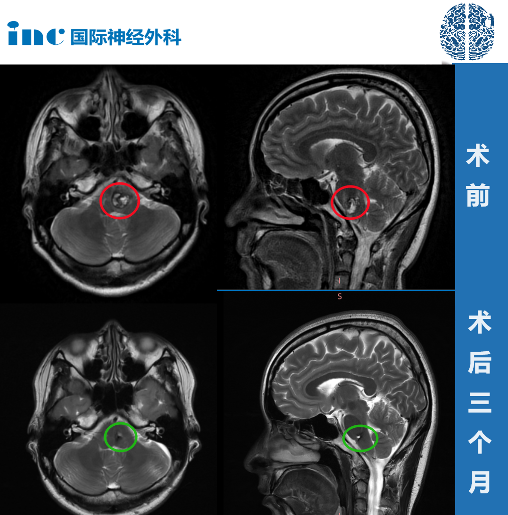 28歲高難度腦干延髓海綿狀血管瘤真實(shí)案例