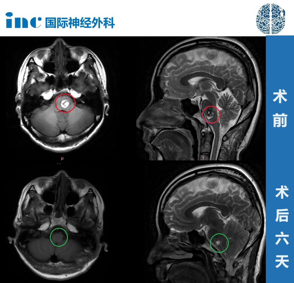 28歲高難度腦干延髓海綿狀血管瘤真實(shí)案例——術(shù)后影像