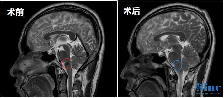 32歲男性-延髓海綿狀血管瘤案例影像