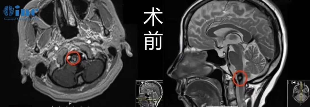 50歲女性-延髓海綿狀血管瘤影像圖片