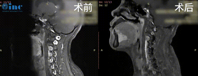 33歲女性-腦干頸髓室管膜瘤