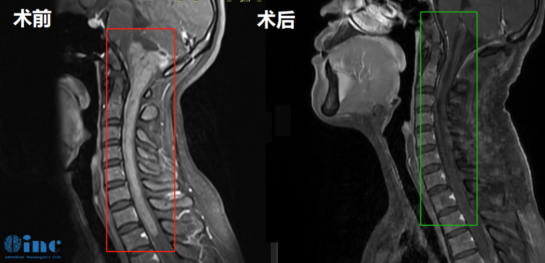 33歲女性-腦干頸髓室管膜瘤影像圖片