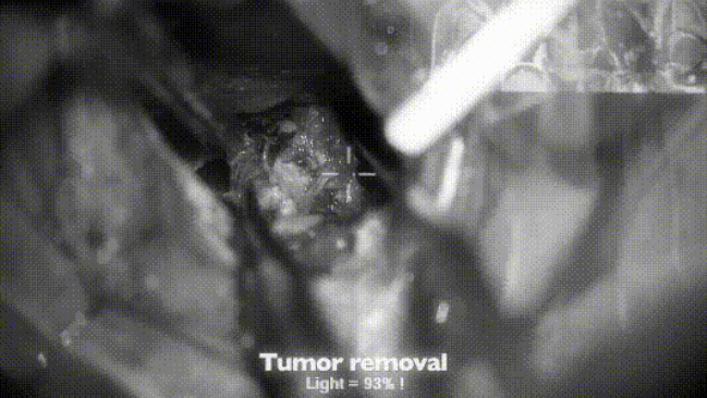 38歲女性蝶眶腦膜瘤腫瘤取出圖片