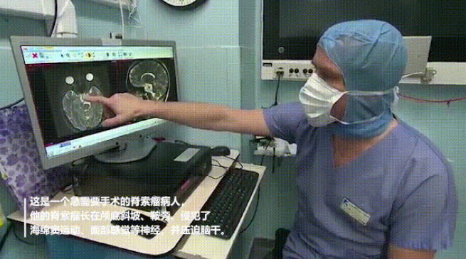 復(fù)雜脊索瘤長在斜坡、鞍區(qū)、侵犯海綿竇  　　不開顱如何順利手術(shù)？