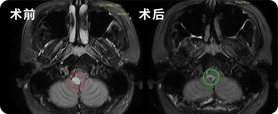 24歲男性-腦干延髓低級別膠質(zhì)瘤