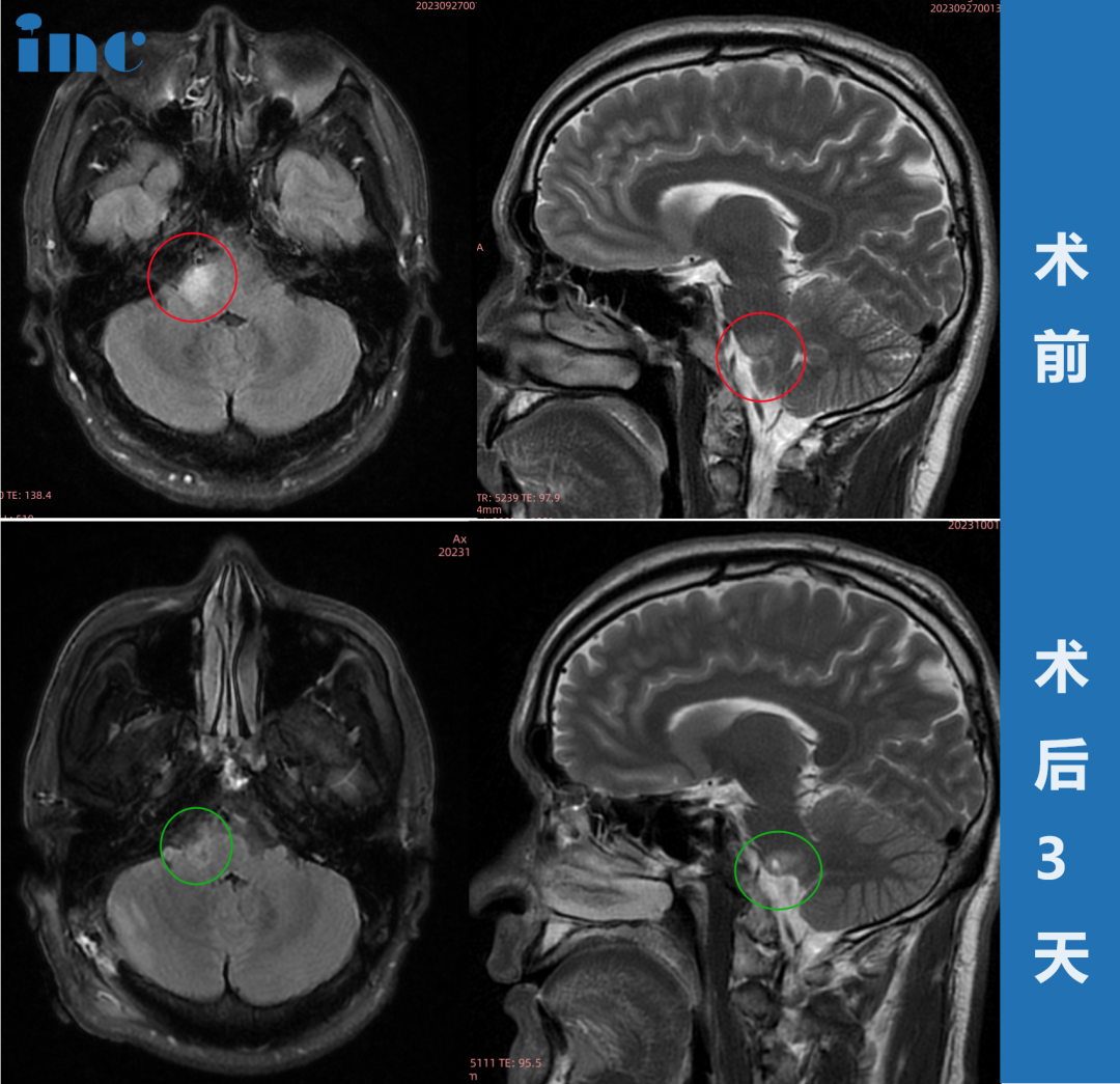33歲男性?腦干-橋臂膠質(zhì)瘤