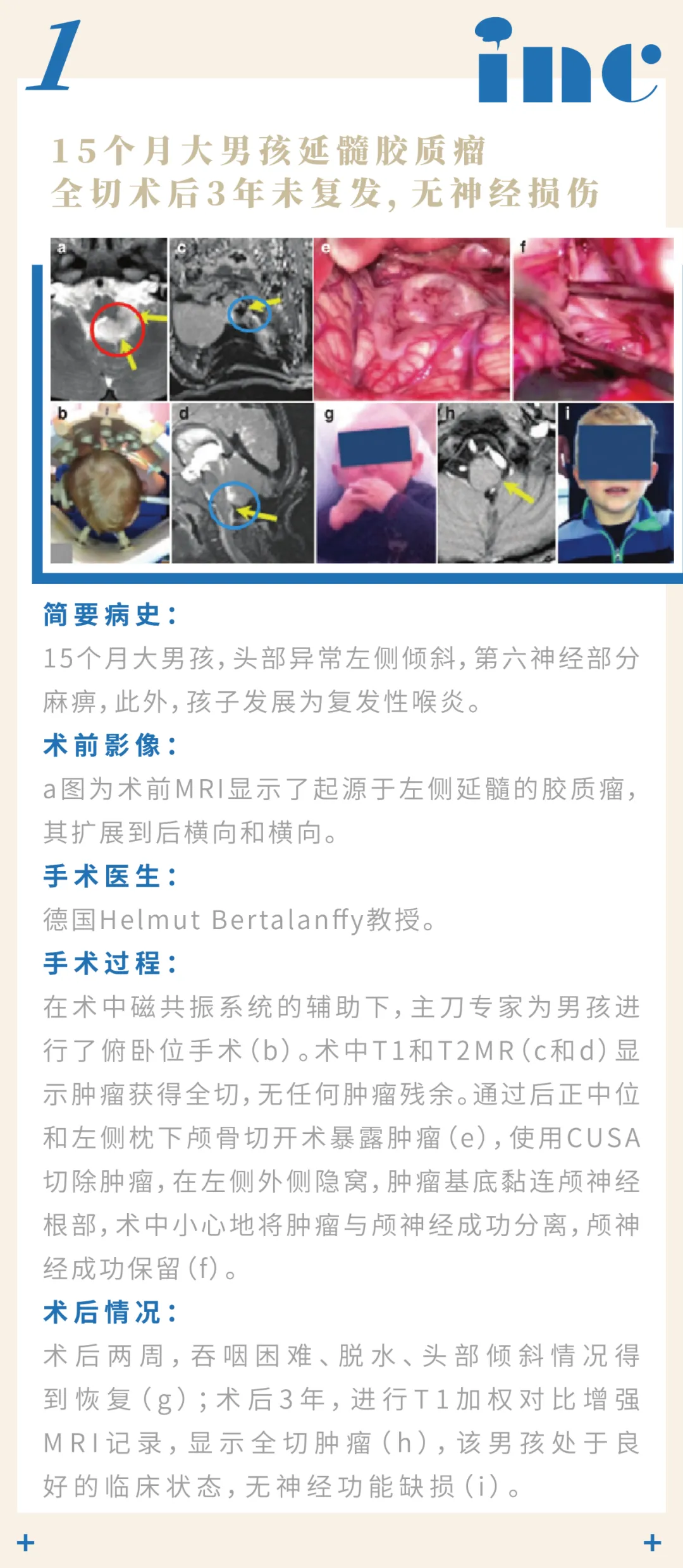 巴特朗菲教授腦干-延髓膠質(zhì)瘤章節(jié)交流案例圖片
