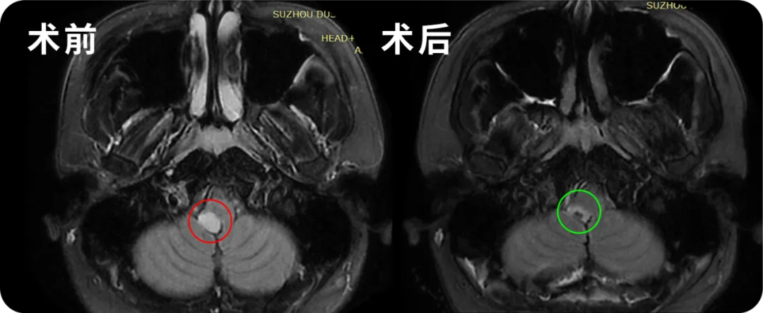 腦干延髓膠質瘤影像圖片