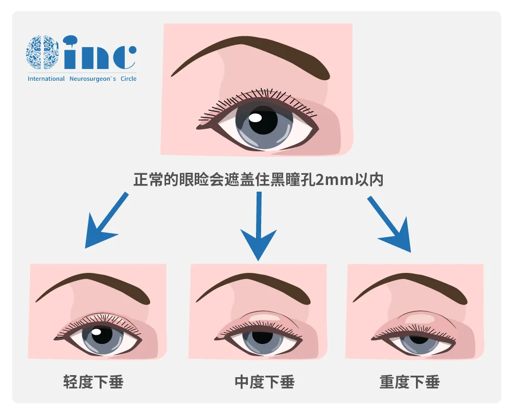 侵襲性垂體瘤實(shí)例交流