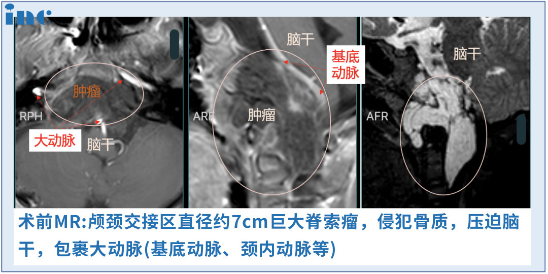 INC法國福洛里希教授真實案例