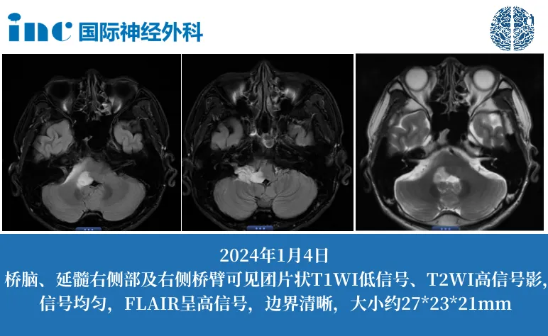 膠質瘤治療案例