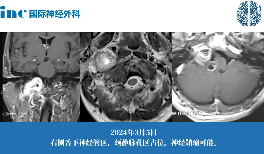 38歲男性-頸靜脈孔區(qū)神經(jīng)鞘瘤案例圖片