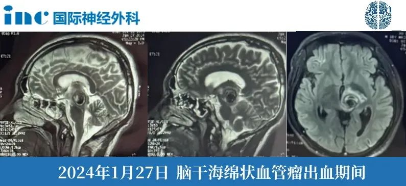 2024年巴教授3月疑難腦瘤示范手術(shù)