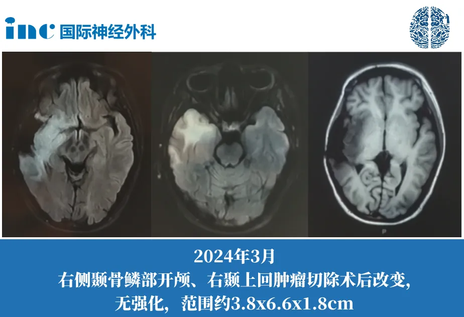 島葉、顳葉、額葉較大膠質(zhì)瘤手術(shù)是首要選擇