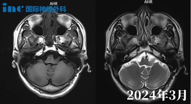 島葉、顳葉、額葉較大膠質(zhì)瘤手術(shù)是首要選擇