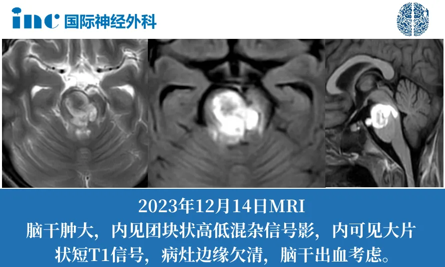 腦海綿狀血管瘤出血
