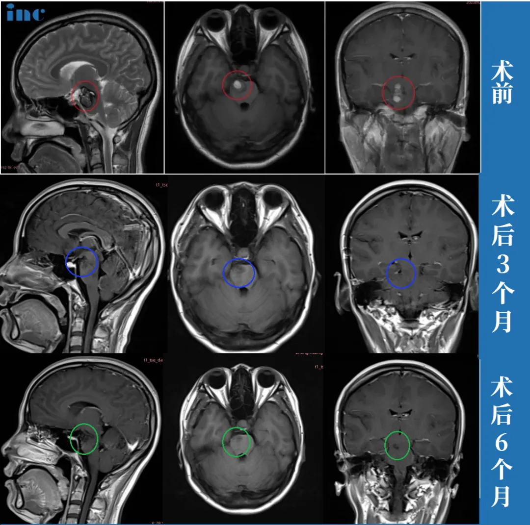 腦海綿狀血管瘤產(chǎn)后出血昏迷案例圖片