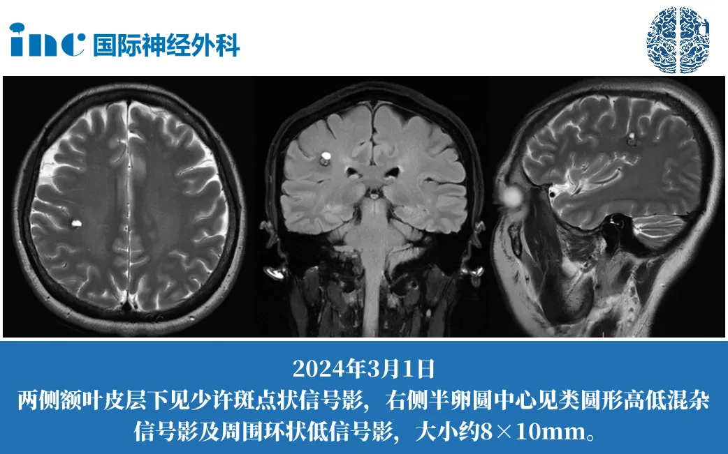 巴特朗菲教授患者案例圖片
