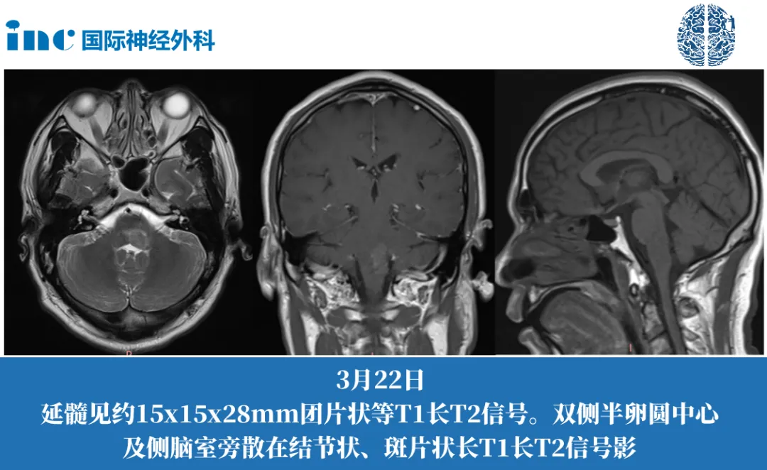 51歲男性-延髓占位性病變圖片