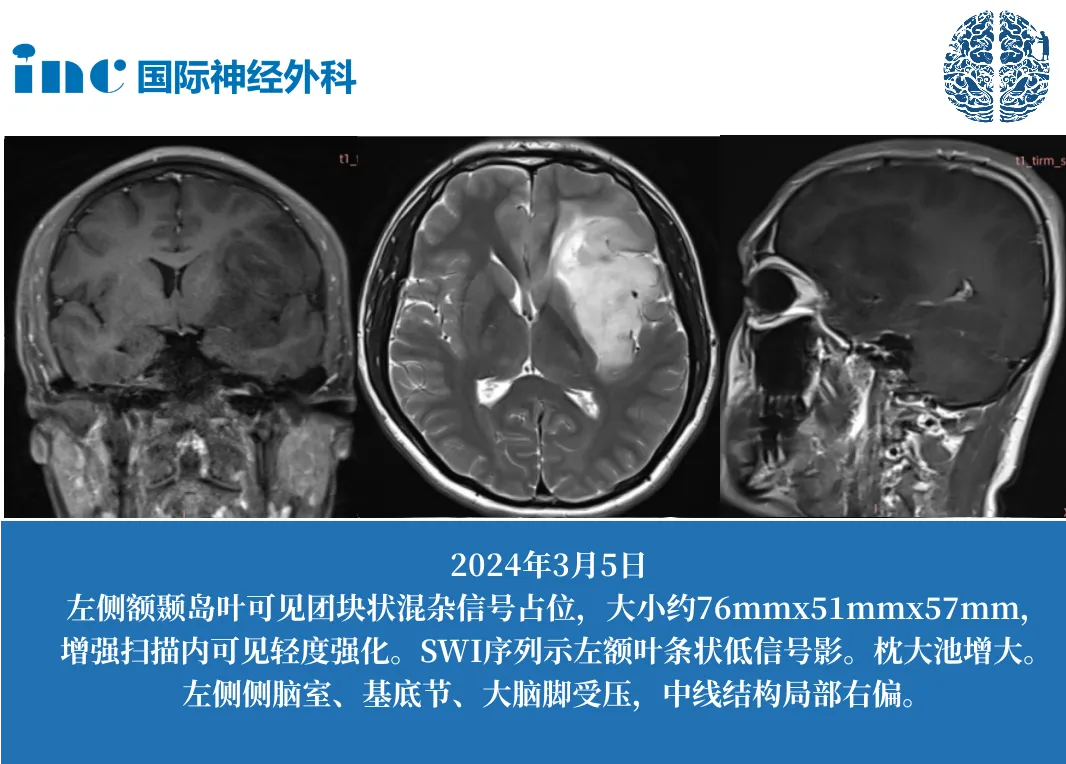 島葉位置的腦腫瘤會(huì)導(dǎo)致<a href='/dianxian/' target='_blank'><u>癲癇</u></a>
