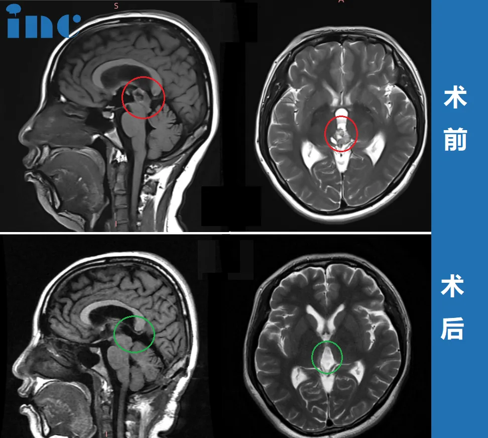 36歲女士——松果體區(qū)腫瘤圖片