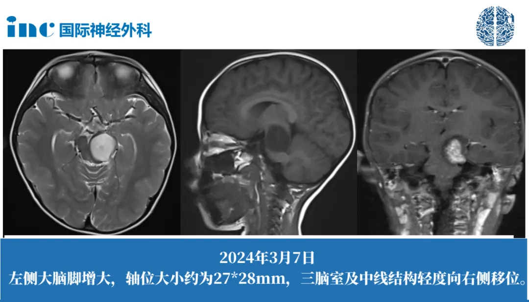 3歲男孩-腦干占位性病變