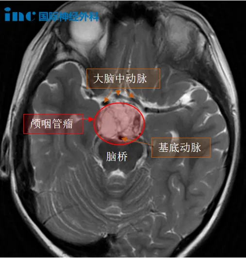 7歲男孩顱咽管瘤影像圖片
