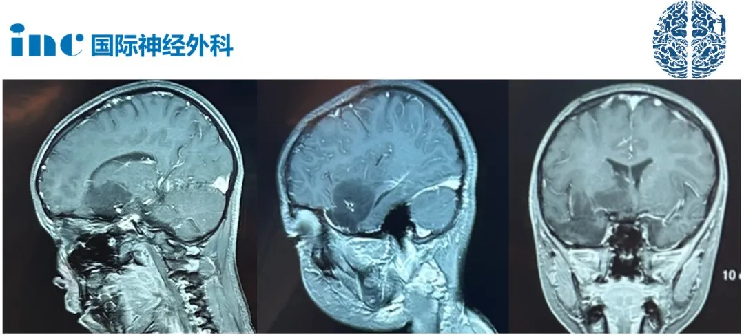 胚胎發(fā)育不良性神經上皮腫瘤DNET