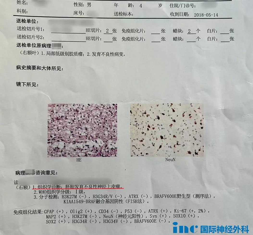 胚胎發(fā)育不良性神經上皮腫瘤DNET檢查