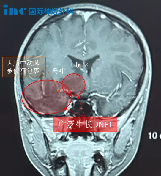 胚胎發(fā)育不良性神經上皮腫瘤DNET