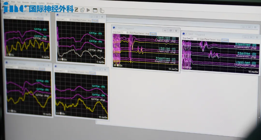 胚胎發(fā)育不良性神經上皮腫瘤DNET——電生理監(jiān)測