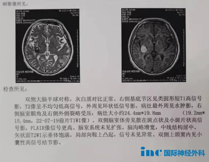 68歲女性--罹患基底節(jié)海綿狀血管瘤