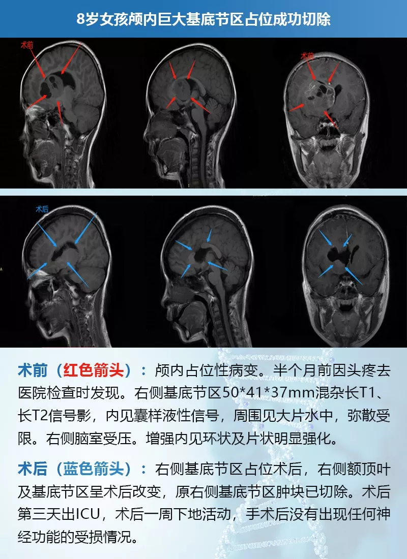 8歲女孩5cm較大基底節(jié)區(qū)腫瘤成功切除記|INC案例交流
