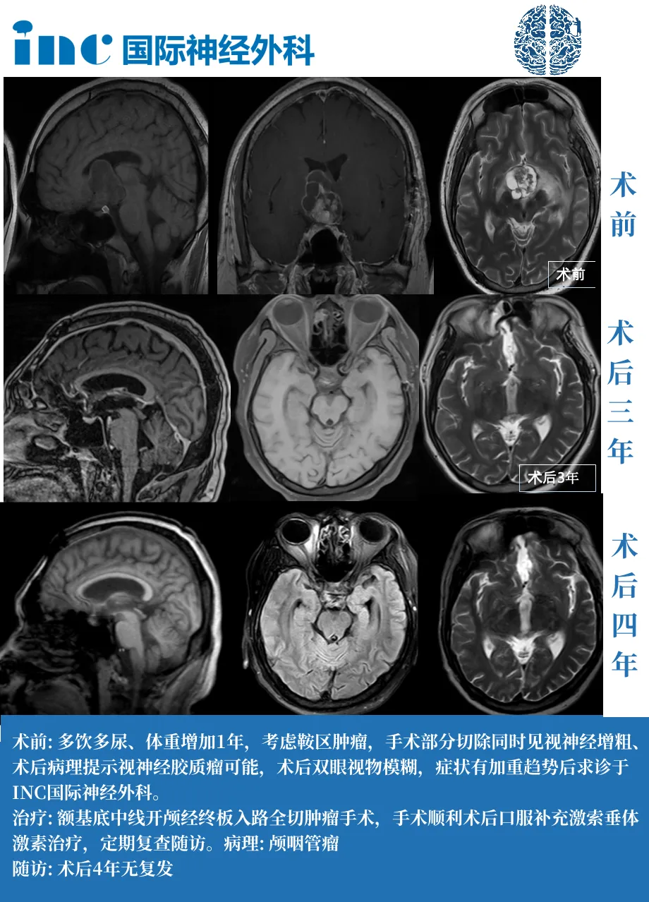 35歲男性——成功全切，術(shù)后4年沒有復(fù)發(fā)