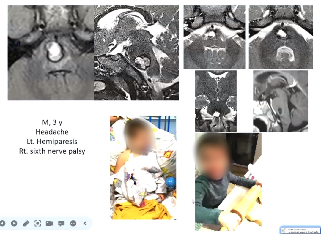 3歲男孩，輕度偏癱六神經(jīng)麻痹。順利全切