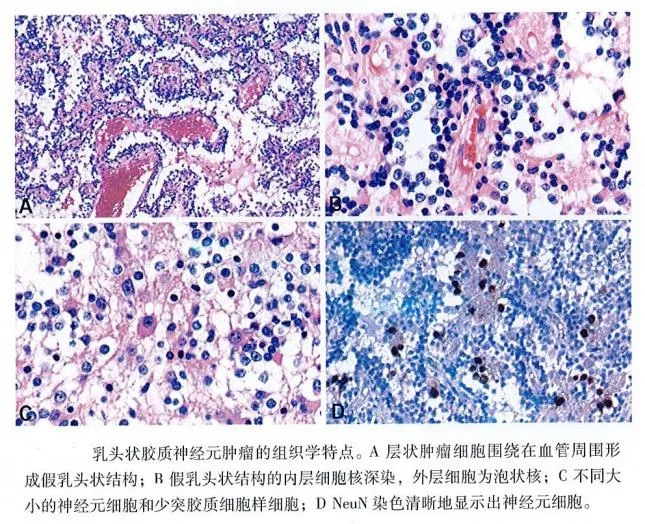 PGNT主要由膠質(zhì)細(xì)胞和向神經(jīng)元方向分化的細(xì)胞構(gòu)成