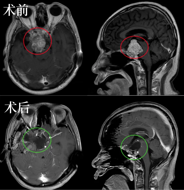 48歲男性反復(fù)復(fù)發(fā)高難度鞍區(qū)脊索瘤