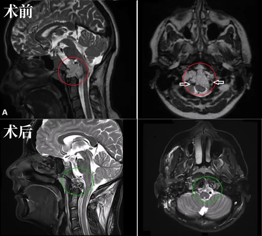 21歲女性顱頸交界區(qū)脊索瘤