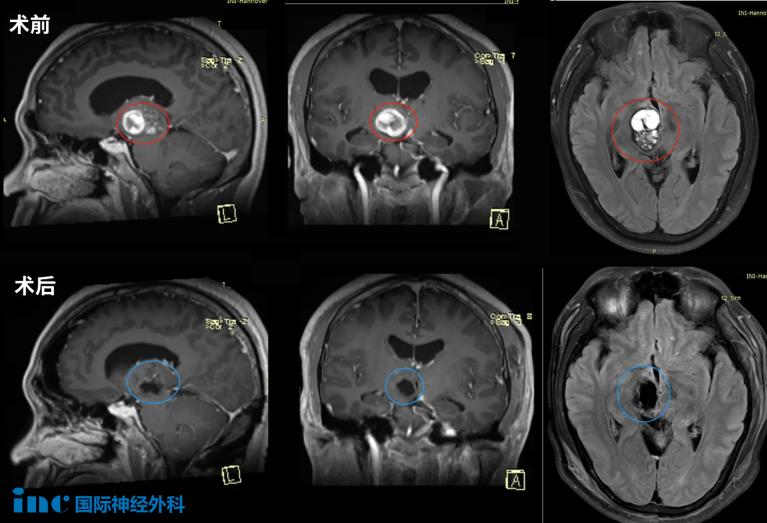 38歲陳先生-腦干中腦海綿狀血管瘤
