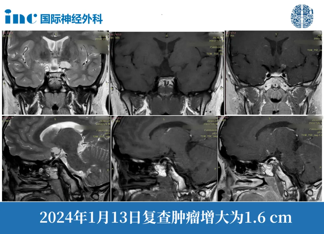 顱咽管瘤影像