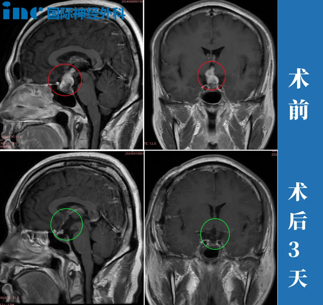 顱咽管瘤影像圖片