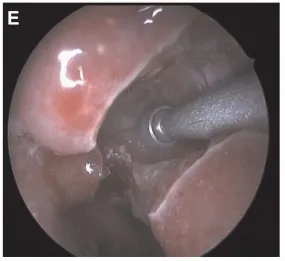 使用3mm高速?gòu)澢饎偸@頭磨除下鼻甲（Midas Rex LegendR telescope,Medtronic,Dublin,Ireland）。在SS下方的上斜坡鉆孔磨除骨質(zhì)以暴露腫瘤（圖E）。