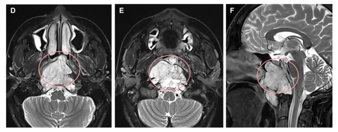 D、E術(shù)前軸向和F矢狀t2加權(quán)MRI
